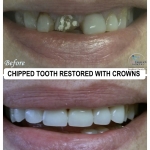 Chipped Tooth Restoration with Crowns by Dr. Le of My Fairfax Dental, VA