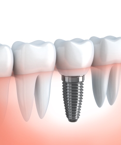 Dental Implants at My Fairfax Dental