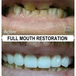 Full Mouth Restoration by Dr. Le of My Fairfax Dental, VA