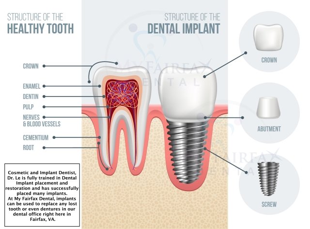Structure of the dental implant
