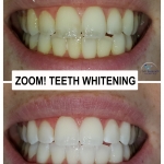 Zoom Whitening by Dr. Le of My Fairfax Dental, VA