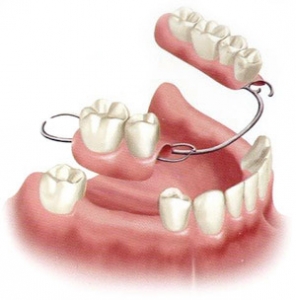 Partial Dentures at Dr. Le Fairfax VA -