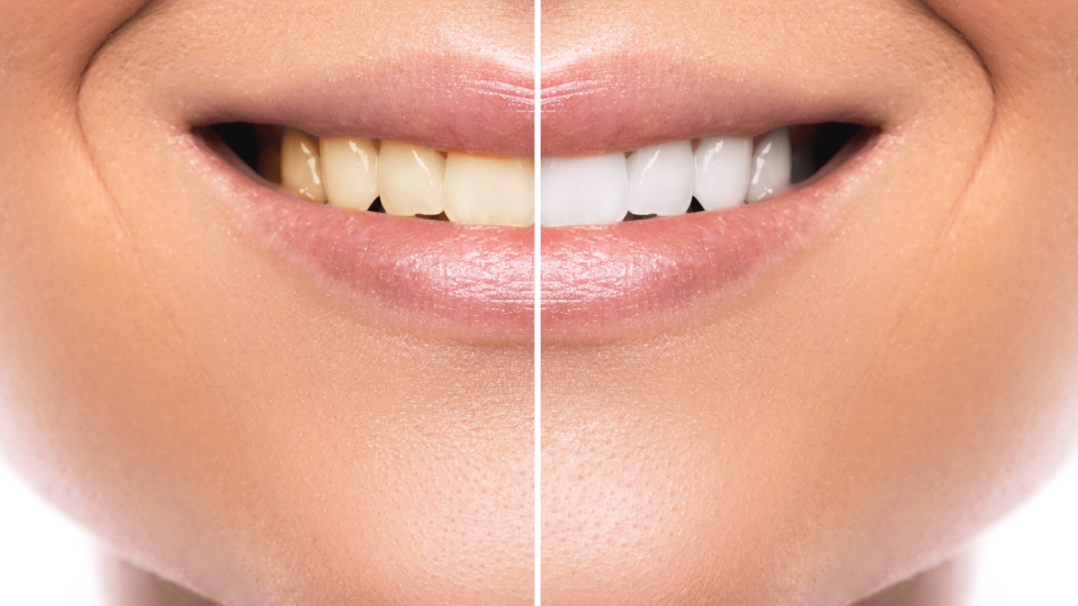 Teeth whitening before and After