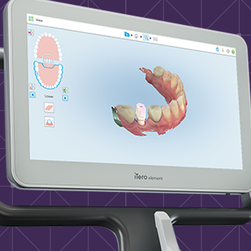 My Fairfax Dental Itero Digital Scanner